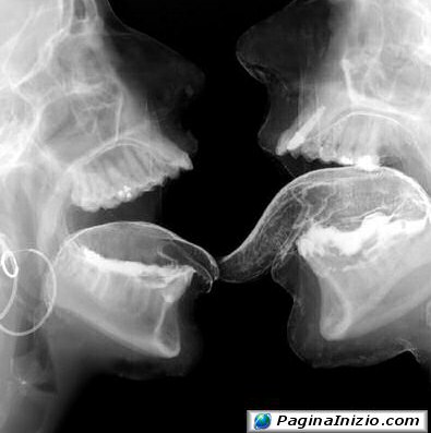 Bacio a raggi X