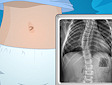 <b>Operazione scoliosi - Operate now scoliosis surgery